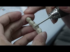 মেটাল সিরামিক ব্রিজ