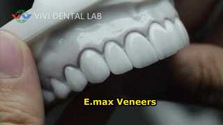 ডেন্টাল Veneers Laminates